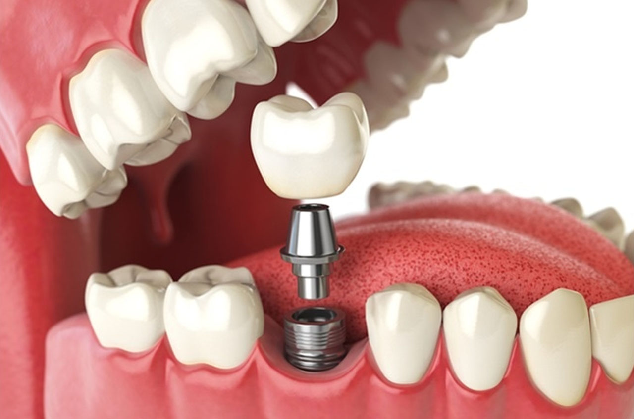 https://s3.wasabisys.com/18dentistry.com/ptfvuserdata/uploads/users/u7759/profile_images/7759_20230818053327_dental-implants bef.jpg